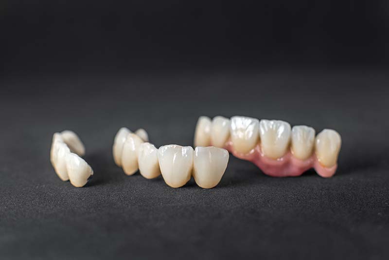 Types of cosmetic dental crowns