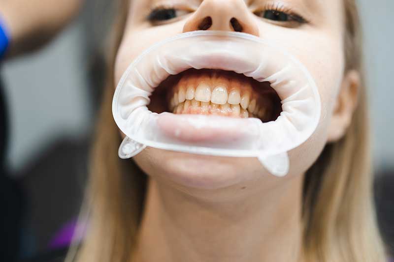 Teeth Whitening in Toronto